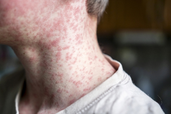 Measles spreads easily. It's one of the world's most contagious diseases.